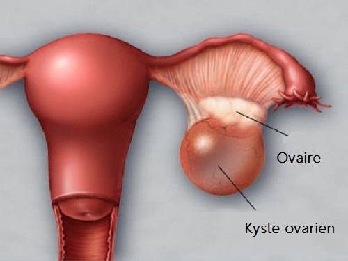 Diagnostic et traitement des kystes ovariens